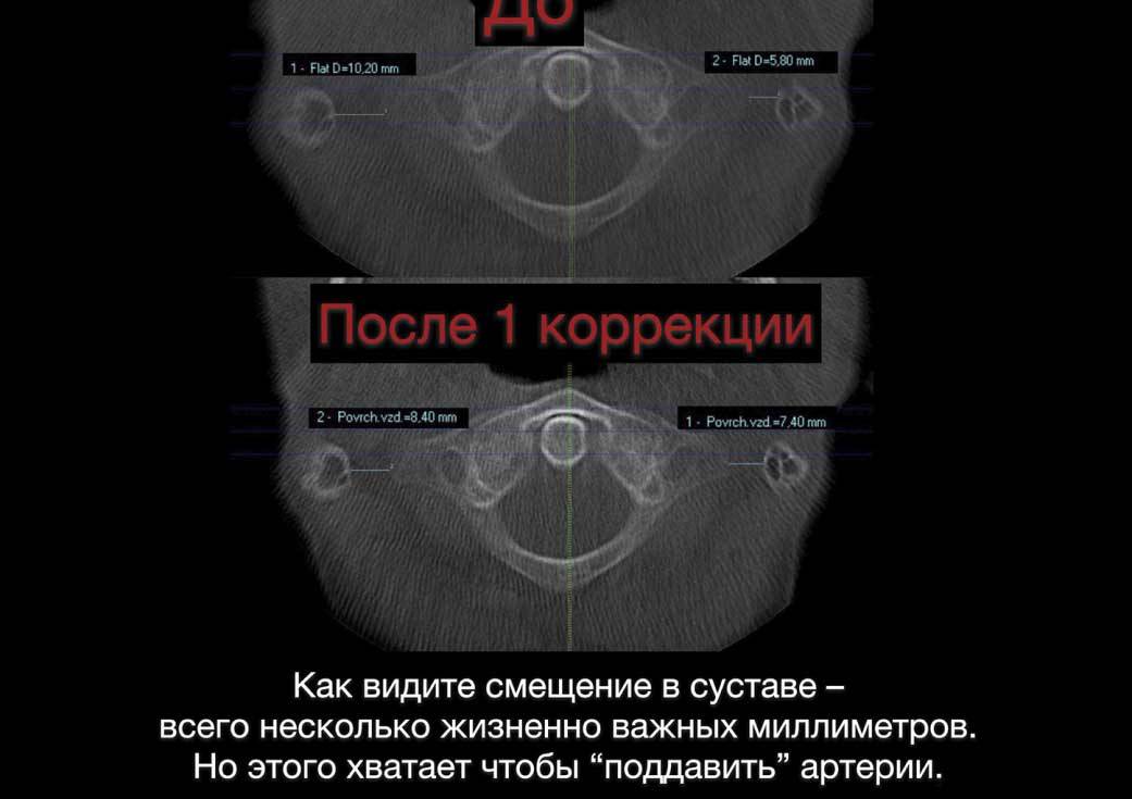 КТ обследование краниовертебральной зоны