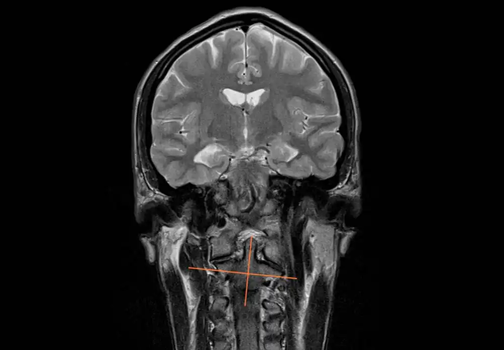 Impact on the nervous system
