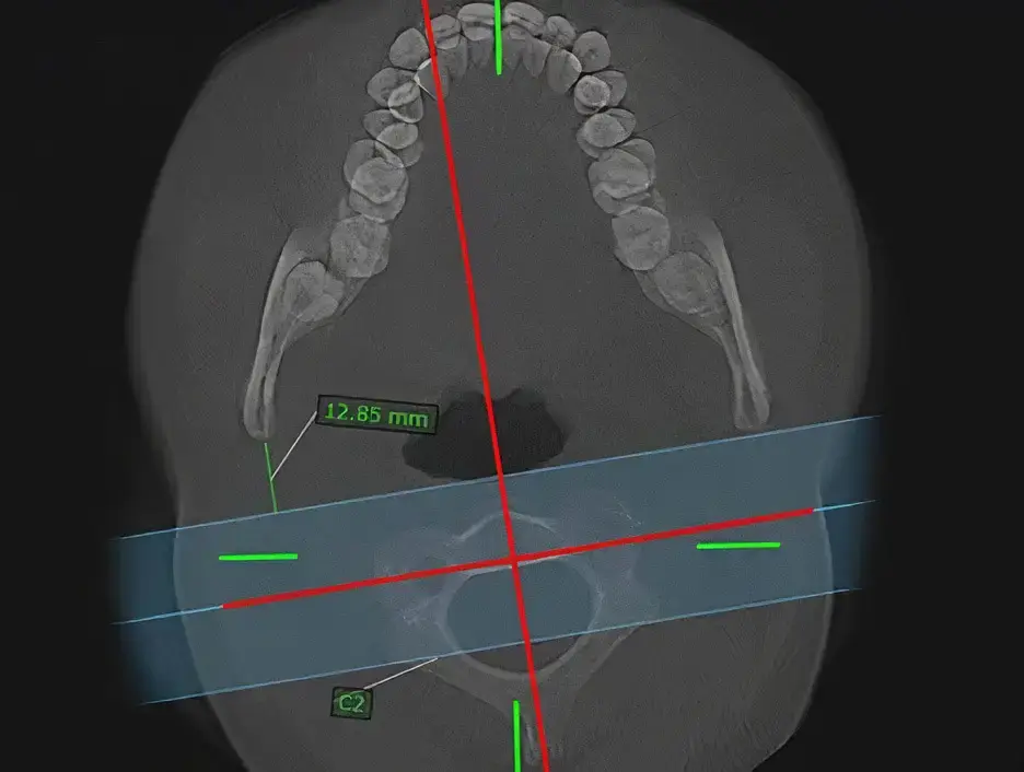 Can osteopathy or manual therapy restore the function of the cervical spine?